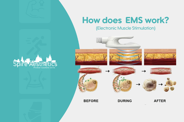 EMS treatment for post pregnancy weight loss treatment Yeovil