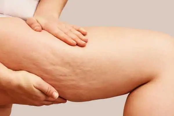 Image of woman showing leg with cellulite Yeovil