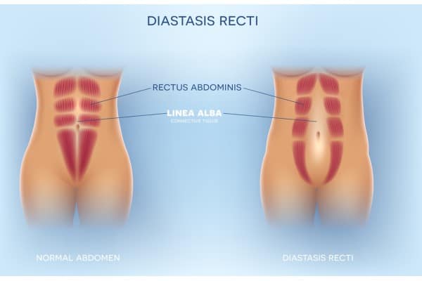 How Does Non-Surgical Treatment Help With Loose Skin, Weak Abdominal Muscles and Post-Pregnancy Changes Yeovil?