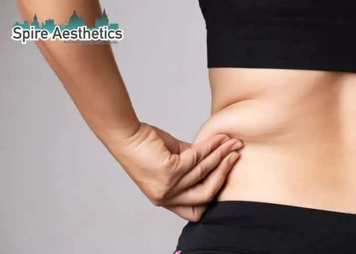 Image of woman pinching fat on their hips Yeovil. Fat Freezing treatment