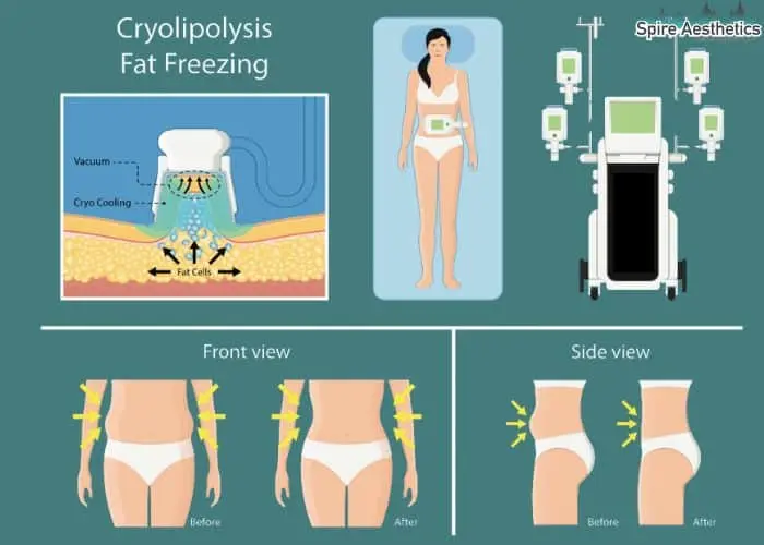 Fat freezing treatment Yeovil benefits for competitions to remove stubborn fat deposits.