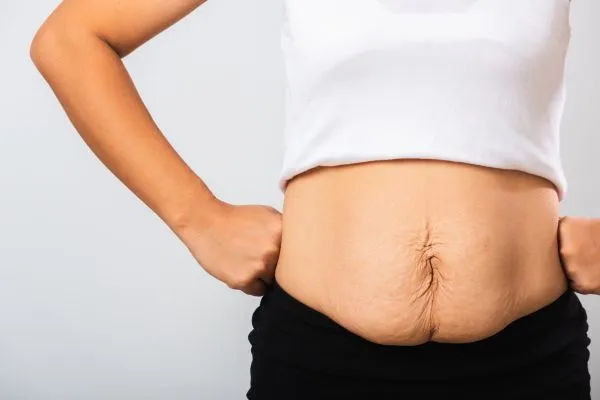 Image of a woman's stomach after weight loss with sagging skin following a gastric band Yeovil