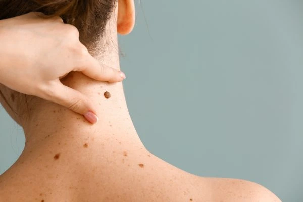 skin blemish removal Yeovil treatment