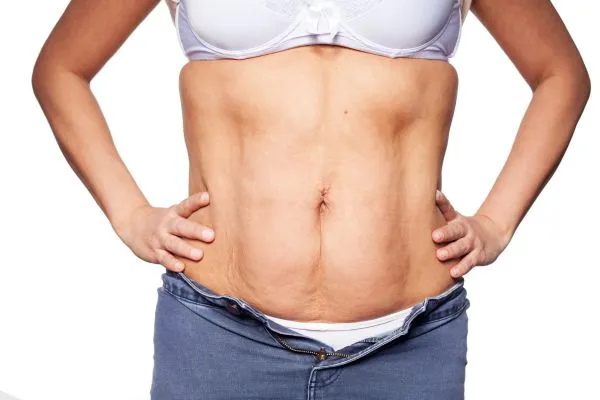 sagging skin on woman's stomach after weight loss injections Yeovil