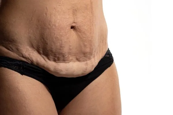Image of womans stomach after weight loss injections Yeovil showing saggy skin