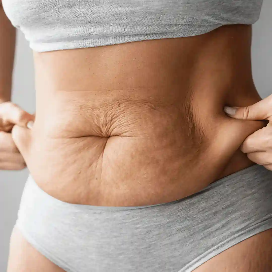 Is It Normal to Have Loose Skin After Pregnancy Yeovil?