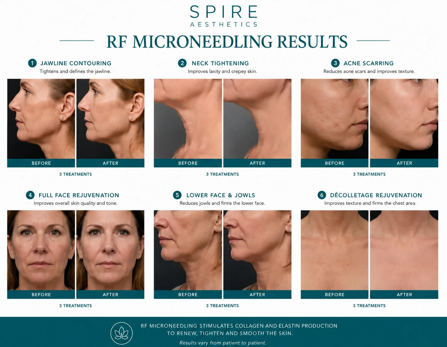 RF Microneedling Skin tightening Yeovil results