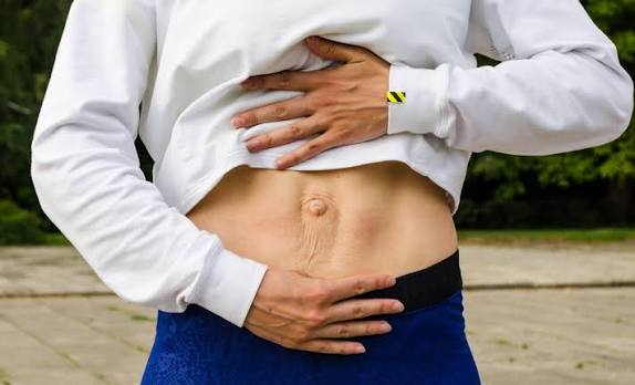 When Could Diastasis Recti Be the Missing Piece of the Puzzle Yeovil?