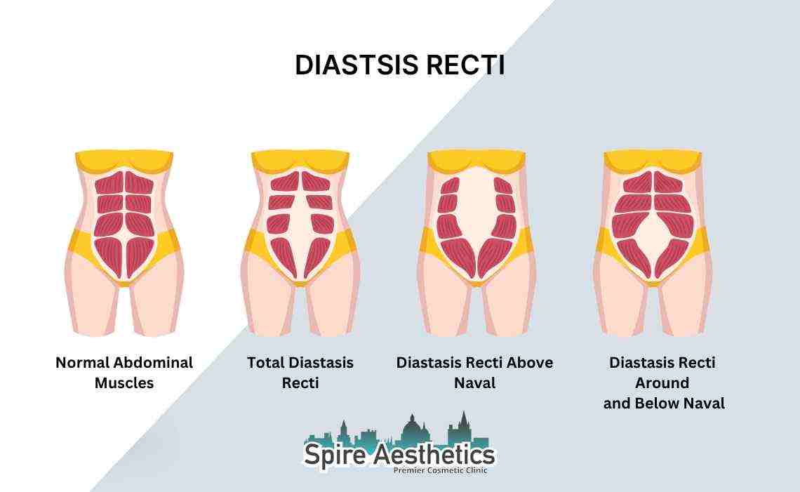Is Non-Surgical Diastasis Recti Treatment Right for You? Common Concerns Answered Yeovil
